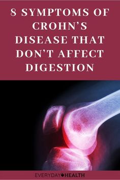 Chrons Disease Symptoms, Crohns Friendly Recipes, Oral Health Care, Chronic Inflammation, Tooth Decay