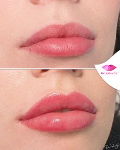 Lip Fillers Juvederm, Lip Color Tattoo, Lip Surgery, Lip Permanent Makeup, Lips Inspiration, Botox Lips, Glossy Eyes, To Love