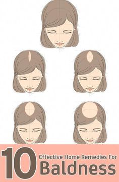 There are some easy home remedies that can assist you in naturally regrowing hair on bald patches. Here are 10 effective home remedies to help you regrow hair. Bad Lifestyle, Bald Patches, Hair Remedies For Growth, Home Remedies For Hair, Regrow Hair, Ombré Hair, Hair Remedies, Proper Nutrition