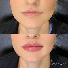 Kysse Lips Filler, Lip Inspo Filler, Lip Fillers Before And After, Lip Injections Before And After, Before And After Lip Fillers, Lip Blushing