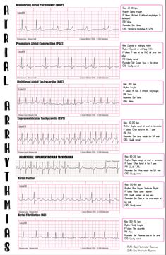 Paramedic Cardiology, Advanced Emt, Nursing School Studying Cheat Sheets, Emt Study, Nursing School Essential, Heart Rhythm, Nursing School Motivation