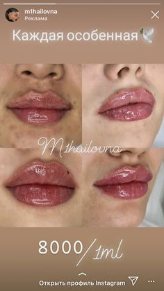 Botox Injection Sites, Lip Augmentation, Film Photography Tips, Lip Filler, Lip Makeup Tutorial, Botox Fillers, Botox Injections