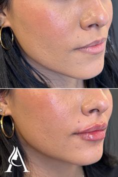 Lips before and after - we're OBSESSED with this first-time lip filler transformation!

Restylane Kysse lip filler in Philadelphia, PA. 

Book a consultation with our amazing injectors at Ari Blanc Medical Spa for your own lip makeover!