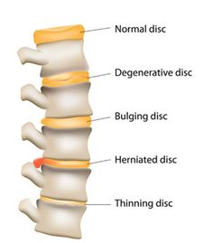 Intervertebral Disc, Bulging Disc, Spine Health, Sciatica Pain, Lower Back Pain, Chiropractic Care, Back Pain Relief, Chiropractic, Massage Therapy