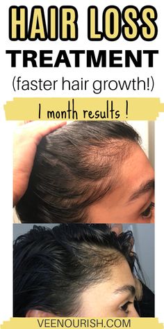 If you’re struggling with hair loss, hair thinning or even bald spots, you’re not alone. Many people struggle with this problem, it can range from mild hair thinning to total baldness and this can happen for many different reasons. Luckily there are many ways to stop the thinning and excessive shedding but, before purs How To Stop Hairfall, Stop Hair Shedding, Hair Fall Remedy Home, Stop Hairfall, Grow Thick Long Hair, Hair Fall Remedy, Hair Growth Formula, Postpartum Hair, Hair Growing Tips