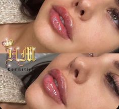 1.5 Lip Filler, Different Types Of Lip Fillers, Kendall Jenner Lip Fillers, Bratz Lip Filler, Babydoll Lip Filler, Angelina Jolie Lip Filler, Lip Filler Shape Ideas Pouty, Bratz Doll Lip Filler, Lip Filler Inspo 1 Ml