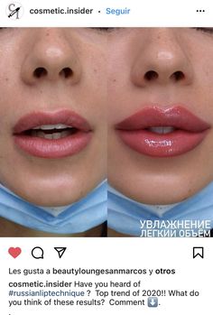 Lip Fillers Before And After 1ml, Russian Lips Filler, Aesthetics Practitioner, Lip Fillers Juvederm, Saggy Cheeks, Dermal Fillers Lips, Botox Brow Lift, Day Eye Makeup, Heart Shaped Lips