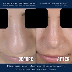 Nose Tip Surgery Before After, Blephoraplasty Before And After, Bulbous Nose Rhinoplasty Before After, Bulbous Nose Rhinoplasty, Nose Rhinoplasty, Nose Plastic Surgery, Nose Surgery Rhinoplasty, Body Surgery, Bulbous Nose