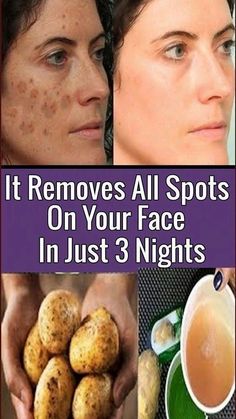 Spots On Forehead, Brown Age Spots, Brown Spots On Skin, Creme Anti Age, Brown Spots Removal, Brown Spots On Face, Skin Spots, Baking Soda Shampoo