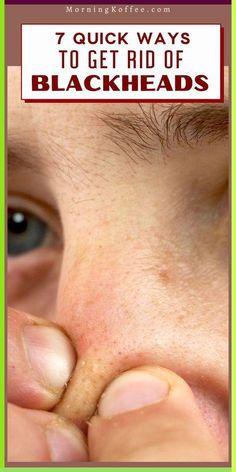 Home remedies to get rid of blackheads : . Egg white mask 2. Milk and honey pore strip 3. Green tea 4. Cocnut oil How To Get Rid Of Oily Face, Homemade Face Mask For Oily Skin, How To Get Rid Of Blackheads, Blackheads Removal Homemade, Face Masks For Blackheads, Neck Pimples, Blackhead Removal Mask, Egg White Mask, Blackheads On Face