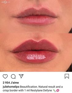 Best Celebrity Lips, Lip Filler Shape Ideas, Pdo Thread Lift, Lip Permanent Makeup, Face Fillers, Shape Ideas