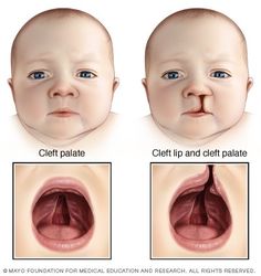 Digeorge Syndrome, Farmhouse Tile, Pediatric Nursing, Medical Knowledge, Upper Lip, Medical Illustration