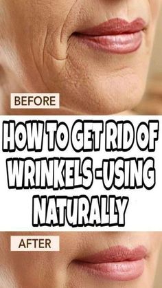 Get Rid Of Age Spots, Natural Wrinkle Remedies, Get Rid Of Wrinkles, Eye Wrinkles, Wrinkle Free Skin, Erase Wrinkles