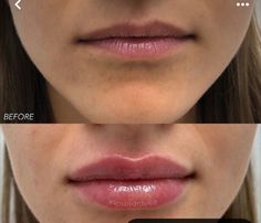 M Shape Lip Filler, Lip Filler Inspo 1 Ml, Lip Filler M Shaped Lips, Lip Filler 1 Ml, Cosmetic Dermatology, Dermatology