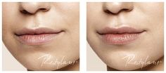 Less is more med Restylane LIP Restylane Lips, Aesthetic Treatments, Botox Filler, Botox Cosmetic, Lip Enhancement, Botox Fillers, Medical Aesthetic, Medical Spa