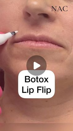 Lips Botox Natural, Lip Botox Natural, Big Upper Lip, Lip Botox Before And After, Lip Inspo Filler, Lip Lift Before And After, Lip Flip Before And After, Lip Filler On Small Lips, 1 Ml Lip Filler Before And After