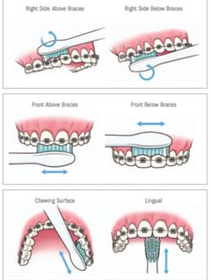 Cute Braces, Kedokteran Gigi, Brace Face