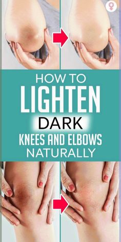 How To Lighten Dark Knees And Elbows Naturally: Do not worry as this discoloration of skin is not a cause for concern or medical risk. Even if it’s not a cause for concern, you can lighten the discoloration with the help of a few remedies that we will discuss in this article. Keep reading to know more. #skincare #skincaretips #beauty #beautytips Dark Elbows, Dark Underarms, Daily Health Tips, Black Knees, Best Anti Aging, Anti Wrinkle, Home Remedies, Health Food, Glowing Skin