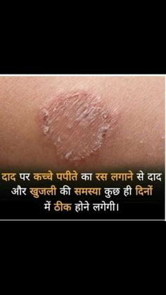 Facebook Stories, Ayurvedic Skin Care, Natural Skin Care Remedies, Good Skin Tips, Beauty Tips For Glowing Skin, Trending Art