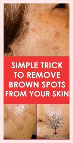 Black Spots On Face, Sunspots On Face, Age Spot Removal, Skin Care Routine For 20s