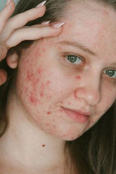 Brain Project, Lemon Face Mask, Closeup Portrait, Pimples On Face