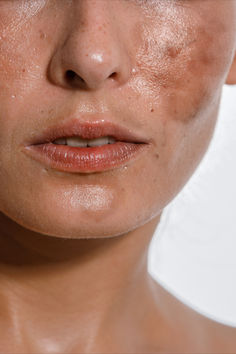 While hyperpigmentation and dark spots can be persistent, a combination of prevention, gentle treatment, and professional care can significantly improve the appearance of your skin. By protecting your skin from the sun, avoiding inflammatory triggers, and using the right skincare products, you can maintain a more even and radiant complexion. Seborrheic Keratosis, Best Serums, Art Modeling, Brightening Skincare, Post Inflammatory Hyperpigmentation, Clean Blackheads, German Beauty, Skin Hyperpigmentation, Facial Aesthetics