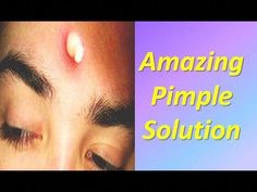 Remove Pimples Permanently  100% Guaranteed – Amazing  Pimple Solution Natural Treatment Click here : http://bit.ly/2oTsCj7Pimple Problem is one of the serio... Pimple Hacks, Blackheads On Cheeks, Pimple Solution, Blind Pimple, Remove Pimples, Pimples Under The Skin, Human Body Temperature, Yoga Information, Pimples Overnight