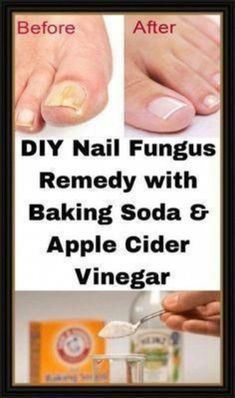 Apple Cider Vinegar Diy, Apple Cider Vinegar Health, Toenail Fungus Remedies, Nail Fungus Remedy, Fungal Nail, How To Grow Nails, Cold Home Remedies, Toenail Fungus, Nail Fungus