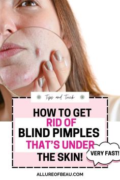 tips and tricks in getting rid of blind pimples How To Get Rid Of Under The Skin Pimples, Deep Pimples Under Skin, Under Skin Pimple, Hard Pimple Under Skin, How To Get Rid Of Pimples Overnight, Hard Pimple, Deep Pimple, Big Zits, Painful Pimple