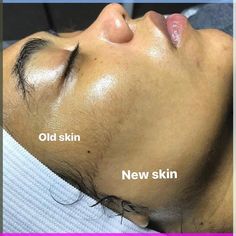 Ageing is a natural part of life, but in today’s beauty world, the ultimate goal is to age gracefully while maintaining beautiful youthful, radiant skin.... Dermaplaning Facial, Dermaplaning Razor, Skin Quiz, Unwanted Facial Hair, Age Gracefully, Facial Peel, Boost Collagen Production, Face Yoga