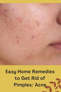 How to get rid of acne fast Remedies For Pimples, Get Rid Of Acne Fast, Home Remedies For Pimples, Get Rid Of Pimples, Rid Of Pimples, Sandalwood Powder, Multani Mitti, Pimples Remedies, Get Rid Of Acne