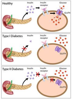 the stages of type i and type ii diabetism in humans, including glucosis