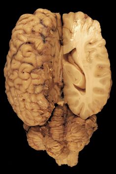 two halves of a human brain are shown in close up, with the left and right hemisphere visible