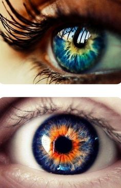 two pictures of an eye with blue and orange irises, one is close up