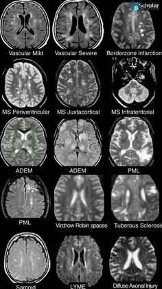 Dive into the fascinating world of neurology! From understanding brain function to discovering new treatments for neurological disorders, learn how science is transforming our knowledge of the mind and nervous system. Radiology Student, Differential Diagnosis, Radiology Imaging, Brain Surgeon, Medicine Notes, Med School Motivation, Medical Wallpaper