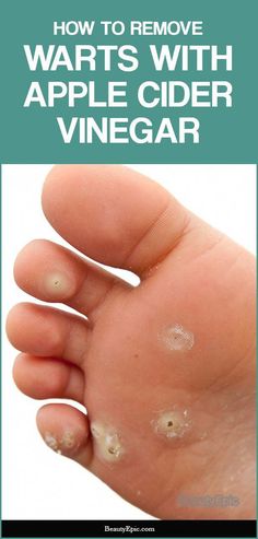 How To Remove Warts, Warts Remedy, Remove Warts, Get Rid Of Warts, Home Remedy For Cough, Skin Natural Remedies, Cold Sores Remedies, Natural Sleep Remedies, Natural Cold Remedies