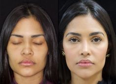 #plasticsurgery #plasticsurgerygonewrong #beforeafter #celebritiesbeforeafter #hollywoodstars #bignosesurgery #surgery #facesurgery #vlinesurgery #koreanplasticsurgery #kpopplasticsurgery #nosejob #jawreductionsurgery #eyesurgery #cheekfillers #rhinoplasty #facelift #plasticsurgeryfails #expensiveplasticsurgery Jaw Reduction Surgery, Ethnic Rhinoplasty, V Line Surgery, Face Fillers, Face Surgery