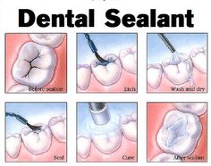 Sealants are easy for your dentist to apply. The sealant is painted onto the tooth enamel, where it bonds directly to the tooth and hardens. This plastic resin bonds into the depressions and grooves (pits and fissures) of the chewing surfaces of back teeth. The sealant acts as a barrier, protecting enamel from plaque and acids. Tooth Extraction Aftercare, Tooth Extraction Healing, Preventive Dentistry, Dental Facts, Dental Bridge, Dental Art