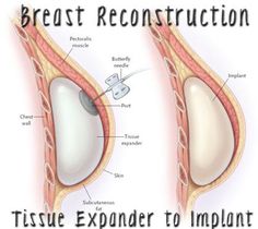 Iv Antibiotics, Subcutaneous Tissue, Phase One