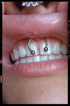 a woman's mouth with two nose rings attached to her teeth and the bottom part of her mouth is missing