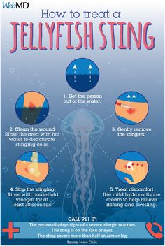 how to treat a jellyfish sting info poster with instructions for use in the ocean