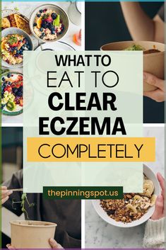 Unveil the secrets to a skin free from eczema with this eczema diet guide I used to heal my eczema. Discover the power of the skin foods in getting rid of eczema, understand the benefits of a skin diet and learn about the best eczema diet to eat. Equip yourself with knowledge on natural eczema treatments and start your journey to heal eczema from the inside out. This guide provides essential insights into the foods you should include and those you should avoid for better skin health. Meals For Skin Health, Foods To Avoid For Excema, Nutrition For Skin Health, Natural Remedy For Excema, Excema Treatments Diy, Excema On Face Skincare, Excema Diet For Kids, Natural Remedies For Excema, Excema Diet