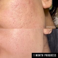 How To Get Rid Of Acne Scars Fast - What Actually Works Cystic Acne Remedies, Remove Skin Tags Naturally, Forehead Acne, Bad Acne, Get Rid Of Acne, Rid Of Acne, Natural Acne Remedies, Acne Scar, Acne Scar Removal