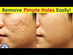 See how to remove pimple holes, acne scars and pimple marks fast andeasily at home.  Subscribe:  https://www.youtube.com/easylifeinfo#removepimpleholes  #rem... Face Pimples How To Remove, How To Remove Acne And Pimple Marks, How To Remove Pimple Scars, Pimples Remove Tips For Girl, Pimple Marks, How To Remove Pimples, Acne