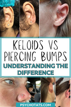 piercing bump vs keloid How To Heal Keloids On Piercings, Keloids Home Remedies Piercing, Keloids Ear Piercing, Piercing Bump, Clear Skin Routine, Hypertrophic Scars, Lymph Fluid, Laser Removal, Clean Blackheads