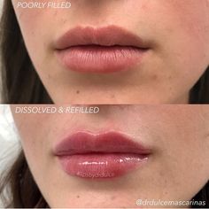 Fox Eyes, Lip Filler, Diy Lips, Skin Products, Dermal Fillers, Cosmetic Surgery