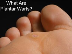 In this blog Dr. Roman Burk, of Rocky Mountain Foot & Ankle, explains what plantar warts are, how to avoid them, and treatments. Click to link to learn more! Plantar Warts, Lip Care Routine, Best Detox, Diy Health, How To Slim Down, Health Lifestyle, Detox Drinks