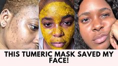 Tumeric Masks, Face Mapping Acne, Overnight Face Mask, Hyper Pigmentation, Tumeric Face Mask, Face Mask Recipe