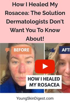 How I Healed My Rosacea: The Solution Dermatologists Don't Want You To Know About! Red Face Remedies, Best Face Wash, Skin Remedies, Skin Care Remedies, Facial Skin Care, Skin Health, Body Skin Care