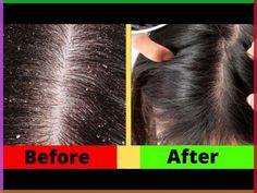 Miracle treatment of dandruff, get rid of dandruff in 1 day. This remedy is very effective. This home remedy is done in just two steps.The best part is, it u... How To Remove Dandruff From Scalp, Get Rid Of Dandruff Permanently, Dandruff Home Remedies, Itchy Scalp Remedy, How To Remove Dandruff, Home Remedies For Dandruff, Rid Of Dandruff, Dandruff Remedy, Getting Rid Of Dandruff